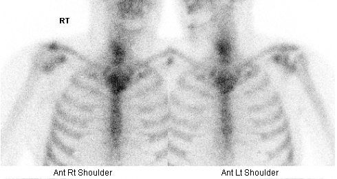 Bone Scan Shoulder Hemiarthroplasty for Osteoarthritis